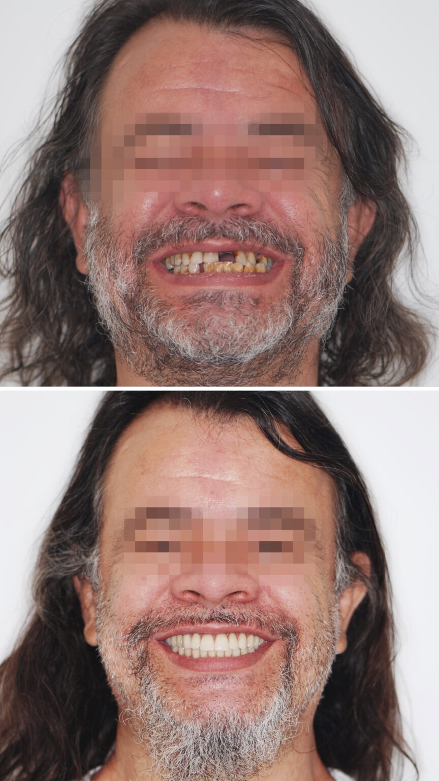 ANTES E DEPOIS DR. WAGNER BRAGA