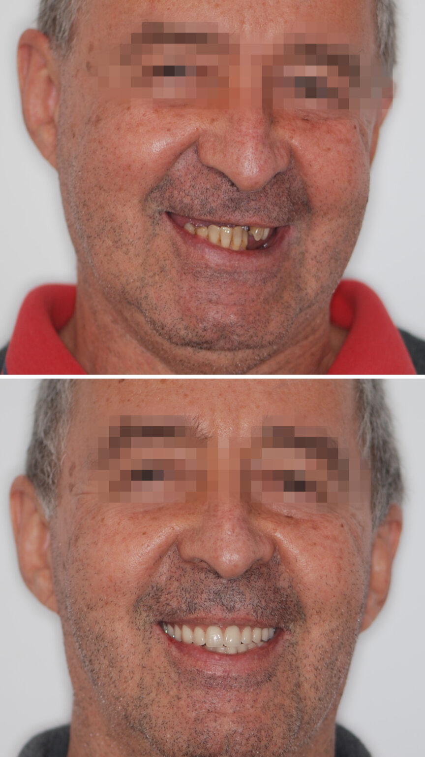 ANTES E DEPOIS DR. WAGNER BRAGA