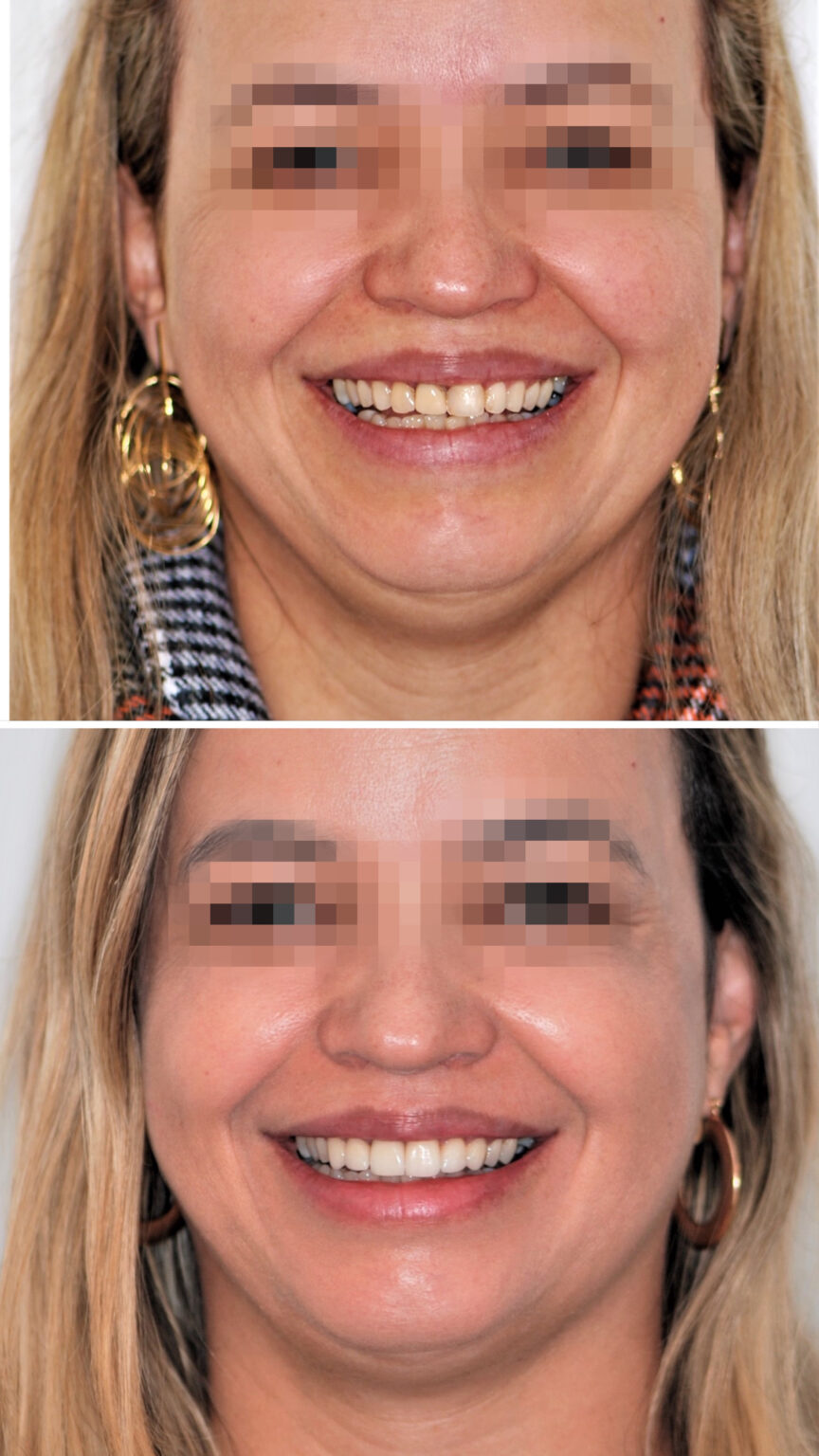 ANTES E DEPOIS DR. WAGNER BRAGA