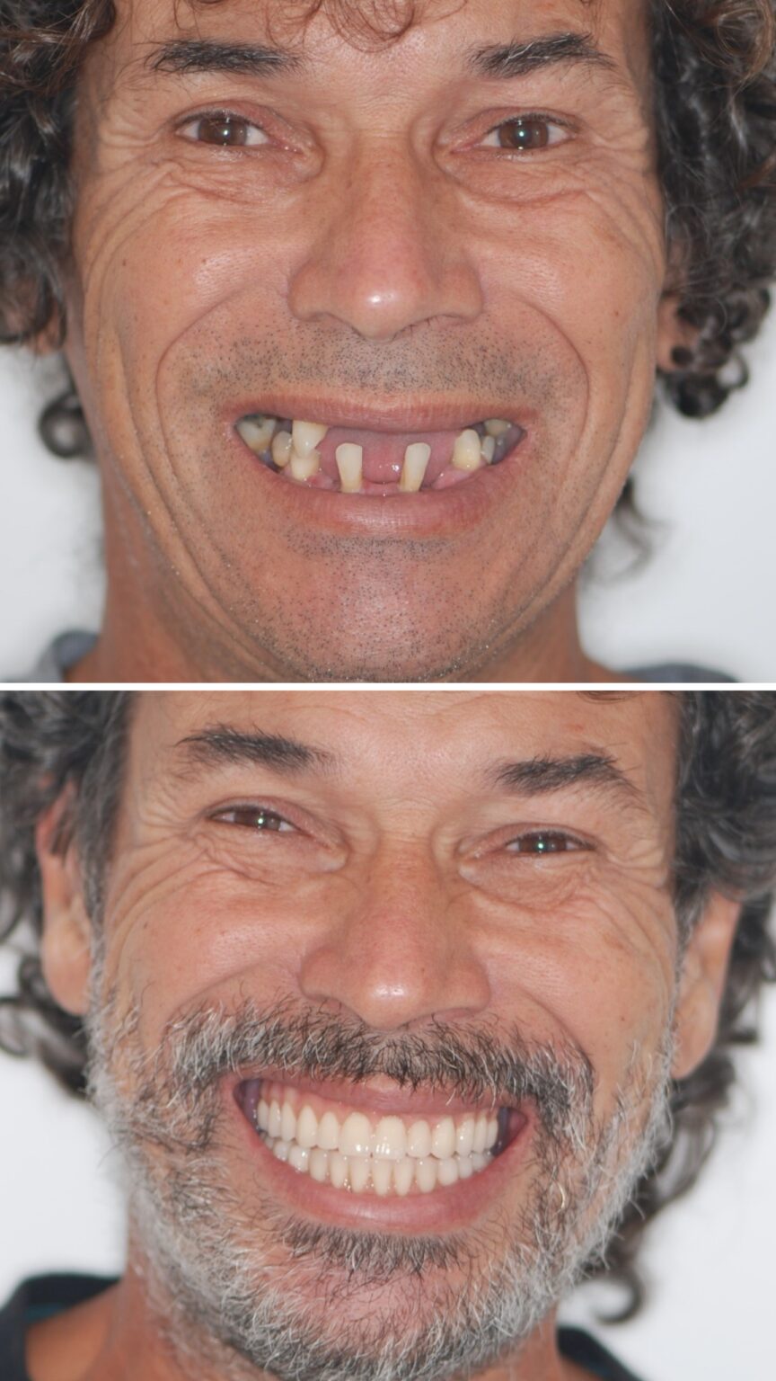 ANTES E DEPOIS DR. WAGNER BRAGA